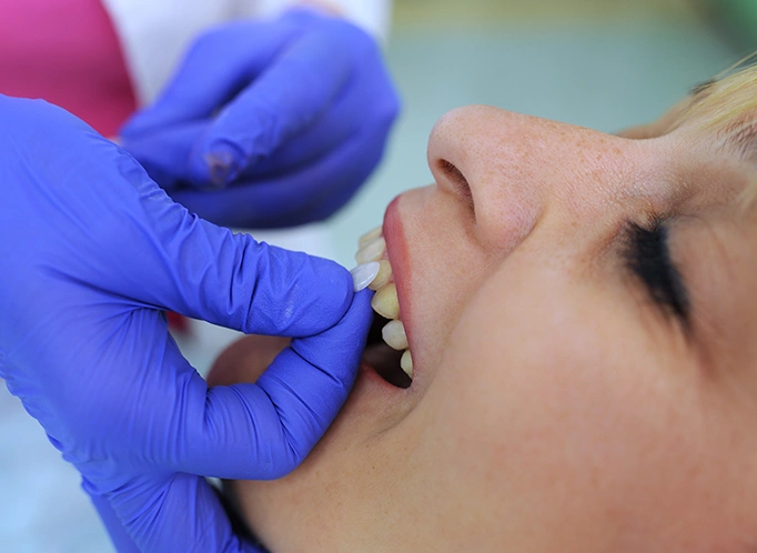 What is the procedure for getting Dental Veneers? - Bayswater Dental Clinic