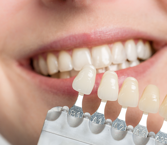 Process of Doing Dental Veneers - Explained by Bayswater Dental Clinic
