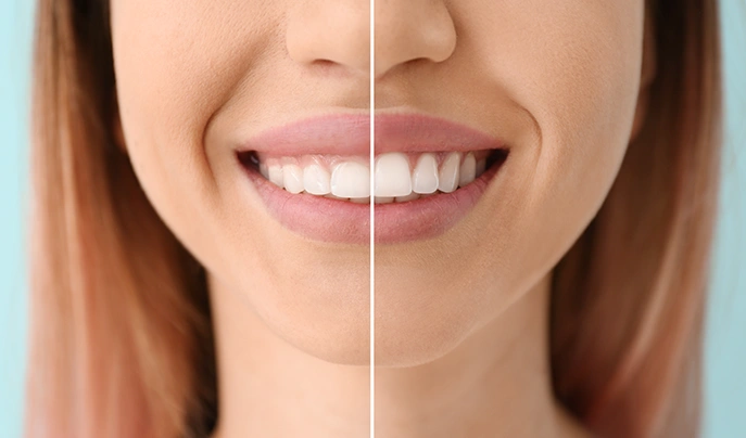 Recovery Time with Laser Gum Contouring - Bayswater Dental Clinic