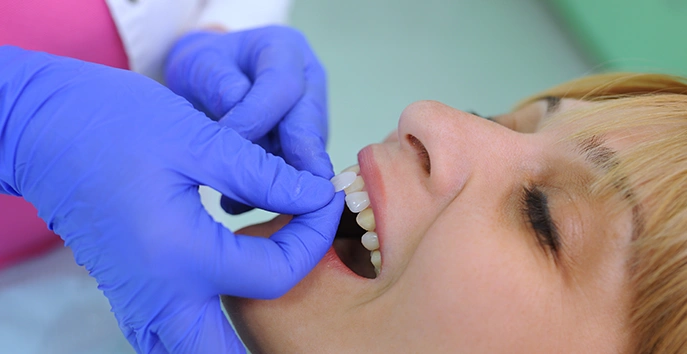 Related Treatments to Porcelain Veneers