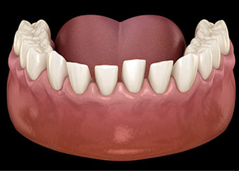 Spaced Teeth Image