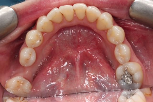 Teeth after dental hygienist treatment